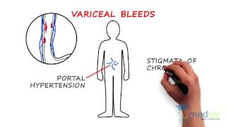 Gastroenterology  Upper GI Bleeding By John Kargbo MD [upl. by Oliver930]