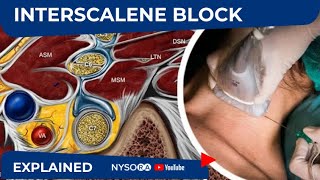 NYSORA Regional Anesthesia Interscalene Block [upl. by Iggy]