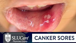 Determining Causes amp Treatment for Canker Sores  SLUCare Otolaryngology [upl. by Schoenfelder]