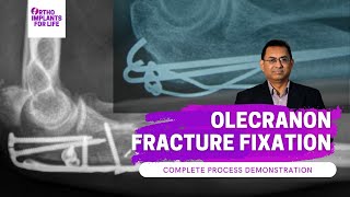 Olecranon Fracture Fixation  Procedure Demonstration [upl. by Goerke34]