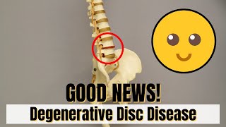 Good News If diagnosed with DDD Degenerative Disc Disease Must Know This [upl. by Warp482]