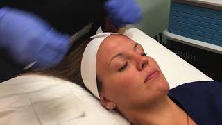 NIKKI GETS A NEW FACE Jessner Chemical Peel Review Before and After [upl. by Trilbi329]