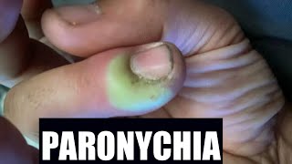 Paronychia  Katuruturu  home remedy and treatment [upl. by Mikes]