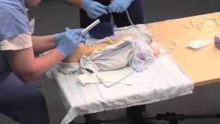 Using a Meconium Aspirator [upl. by Aihsat20]