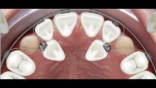 Orthodontic case report for palatally impacted canines traction [upl. by Kentiga424]