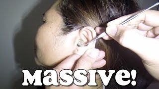 Womans Massive Solid Rock Hard Earwax Removal [upl. by Lletnwahs]