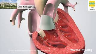 Tetralogy of Fallot by M Mazwi  OPENPediatrics [upl. by Stanton]