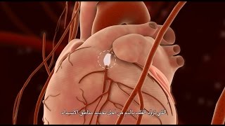 Percutaneous Coronary Intervention PCI [upl. by Ardnovahs809]