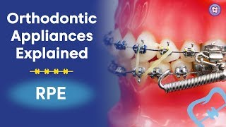 Orthodontic Appliances Explained  RPE [upl. by Wenda709]