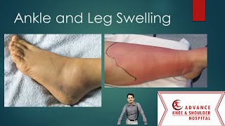 Top 10 causes of Ankle and Leg Swelling [upl. by Namzed]