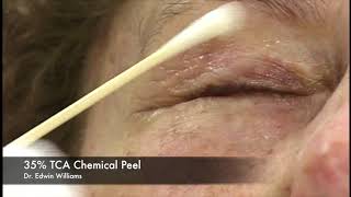 35 TCA Chemical Peel by Dr Edwin Williams for Wrinkles amp Sun Damage [upl. by Eneg]