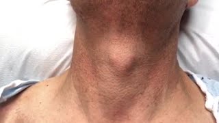 Jugular Venous Pulsations in Constrictive Pericarditis [upl. by Tsyhtema71]