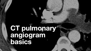 Pulmonary CT Angiogram Basics [upl. by Alexi]