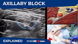 Ultrasound Guided Axillary Brachial Plexus Block NYSORA Regional Anesthesia [upl. by Koorb]