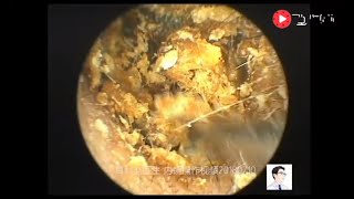 Removal of external auditory canal cholesteatoma by ear endoscopy 19 minutes [upl. by Elleyoj]