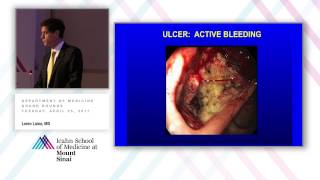 Management of Upper GI Bleeding [upl. by Knuth16]