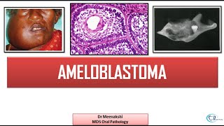 Ameloblastoma  Benign Odontogenic Tumor [upl. by Tedmund]