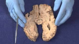 Basal Ganglia Neuroanatomy Video Lab  Brain Dissections [upl. by Ambler375]