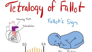 Tetralogy of Fallot TOF  Part 1  Components amp Murmur Explained  Dr Saykat [upl. by Llekcor]