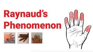 Raynaud’s Phenomenon  What You Should Know  Johns Hopkins Medicine [upl. by Ynaiffit]