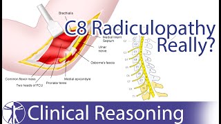 Ulnar Nerve Entrapment mimicking C8 Radiculopathy [upl. by Etom]