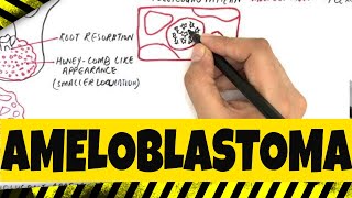 Ameloblastoma  Origination Clinical Radiographic amp Histopathologic features [upl. by Arrekahs]