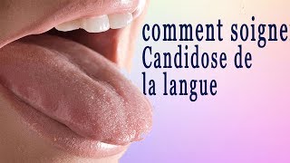 comment traiter Candidoses de la langue [upl. by Uhsoj]