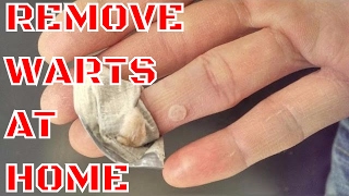 WART REMOVAL  HOW TO REMOVE WARTS AT HOME [upl. by Asilrak]