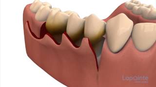 Periodontal flap approach surgery  Lapointe dental centres [upl. by Marisa]