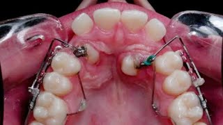 orthodontic treatment for palatally impacted canine WAIT 🔥 [upl. by Bekah]