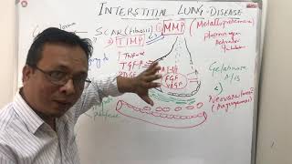 Interstitial lung diseasepathophysiology [upl. by Latoye778]