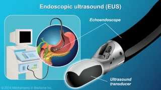 Understanding EUSFNA [upl. by Ynohtn]