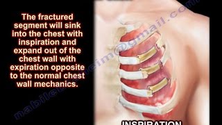 Flail Chest  Everything You Need To Know  Dr Nabil Ebraheim [upl. by Ekal426]