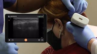 Scanning Technique Occipital Nerve Block [upl. by Kissee215]