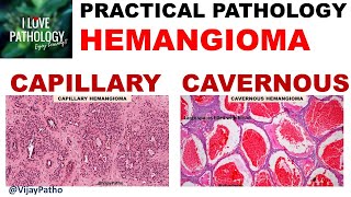 HEMANGIOMA capillary amp Cavernous Clinical features amp Morphology [upl. by Ecidnarb]