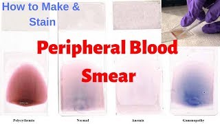 Peripheral Blood Smear Peripheral Smear Examination  Leishmans Staining Procedure [upl. by Chancelor500]