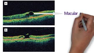 Optical Coherence Tomography  OCT  part2 [upl. by Wash660]