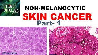 SKIN CANCER Non Melanocytic Part 1 Anatomy Etiopathogenesis amp Classification [upl. by Harragan]