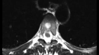 Typical and Atypical Hemangioma [upl. by Leile]