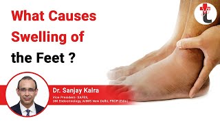 What Causes Swelling of the Feet  Swelling of the feet [upl. by Anthe590]