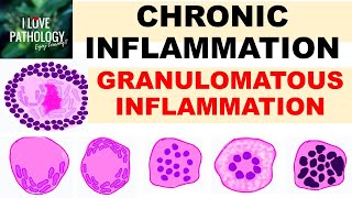 INFLAMMATION Part 9 Chronic Inflammation  GRANULOMATOUS INFLAMMATION [upl. by Assiran]