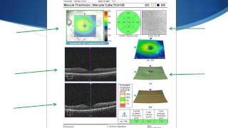 OCT Tutorial On Interpreting Cirrus OCT Macular Scans [upl. by Hickie]