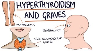 Graves Disease  Overview causes pathophysiology investigations and treatment [upl. by Loren]