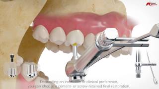 On1 concept intraoral scanning  Nobel Biocare [upl. by Eiduam125]