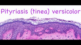 Pityriasis tinea versicolor [upl. by Effy473]