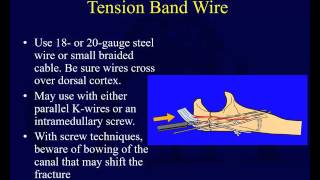 Olecranon Fractures [upl. by Schecter]