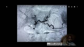 Treating GI bleeding with EMBOLIZATION [upl. by Cardwell32]