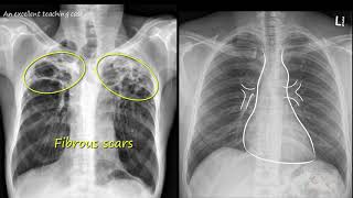 Chest x ray  Tuberculosis healed TB Inactive TB [upl. by Osbourne]