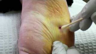 Surgical Plantar Wart Removal [upl. by Jeanne]