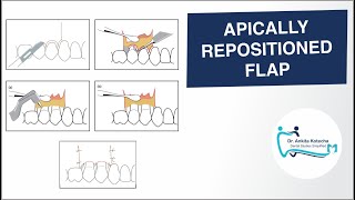 APICALLY REPOSITIONED FLAP PERIODONTAL FLAP SURGICAL TECHNIQUE DR ANKITA KOTECHA [upl. by Revlis788]